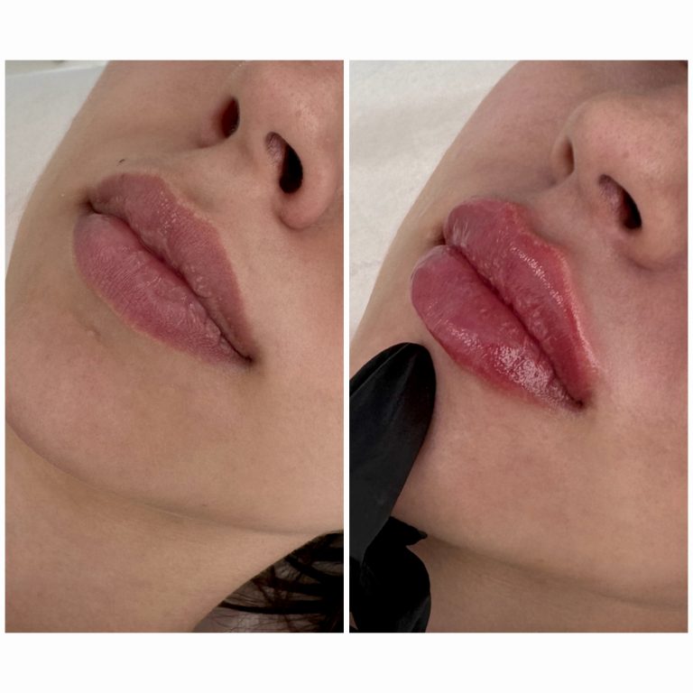 buze injectate cu acid hialuronic