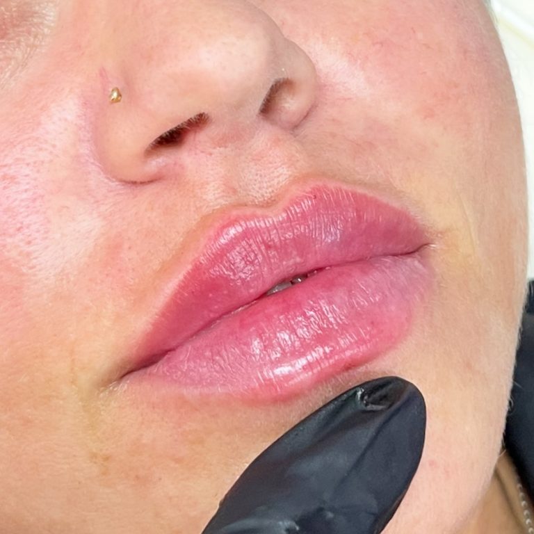 Marire Buze cu acid hialuronic