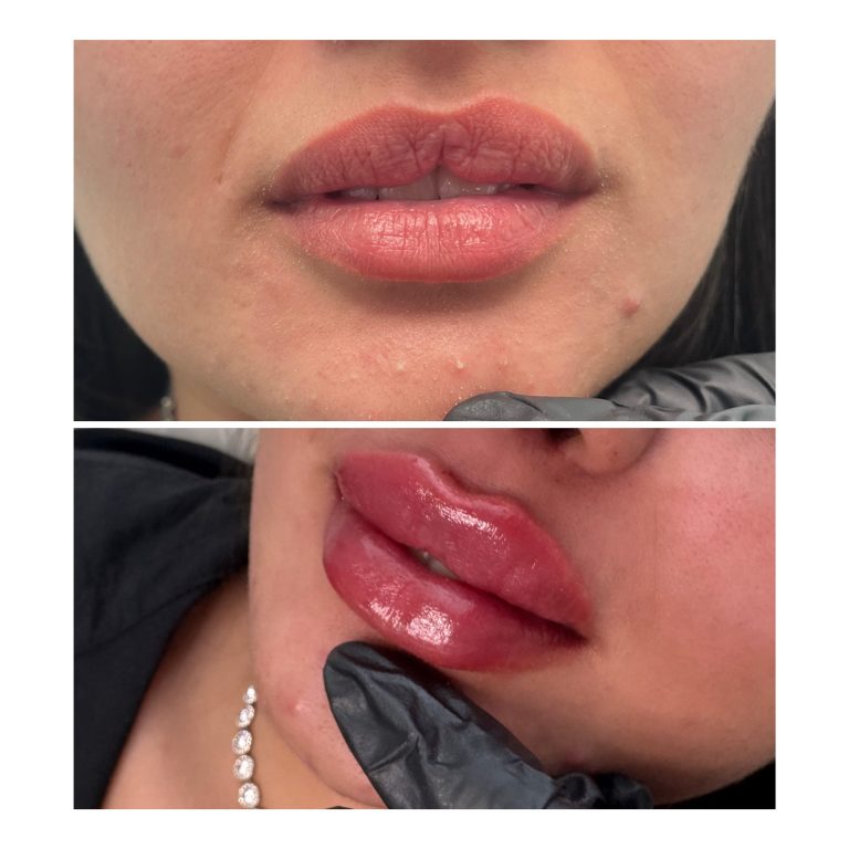 Marire Buze cu acid hialuronic