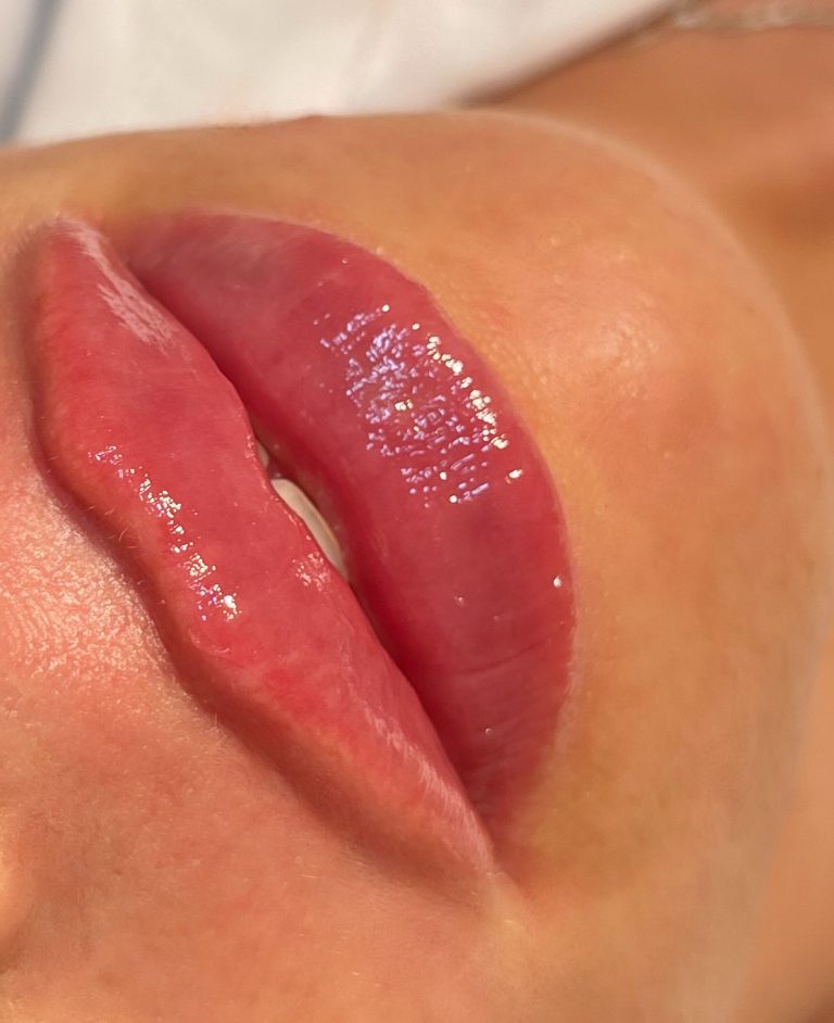 volumizare buze cu acid hialuronic