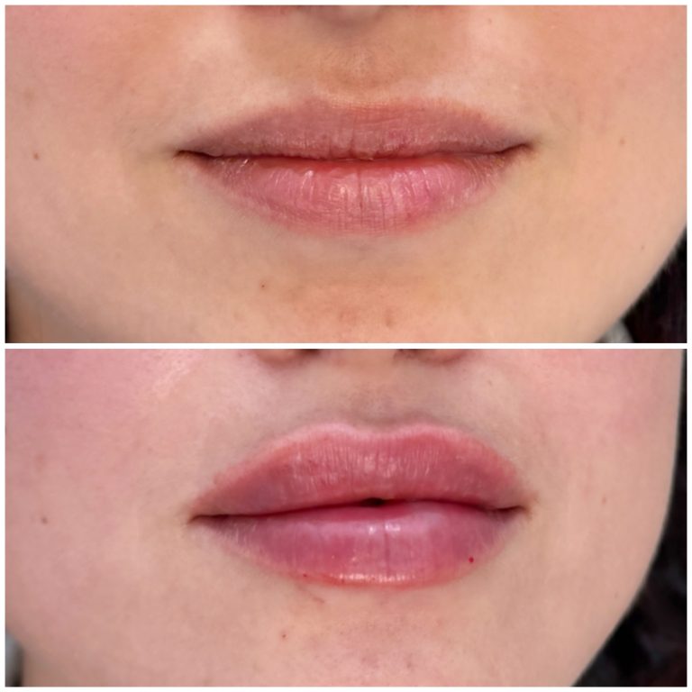 Injectare buze cu acid hialuronic