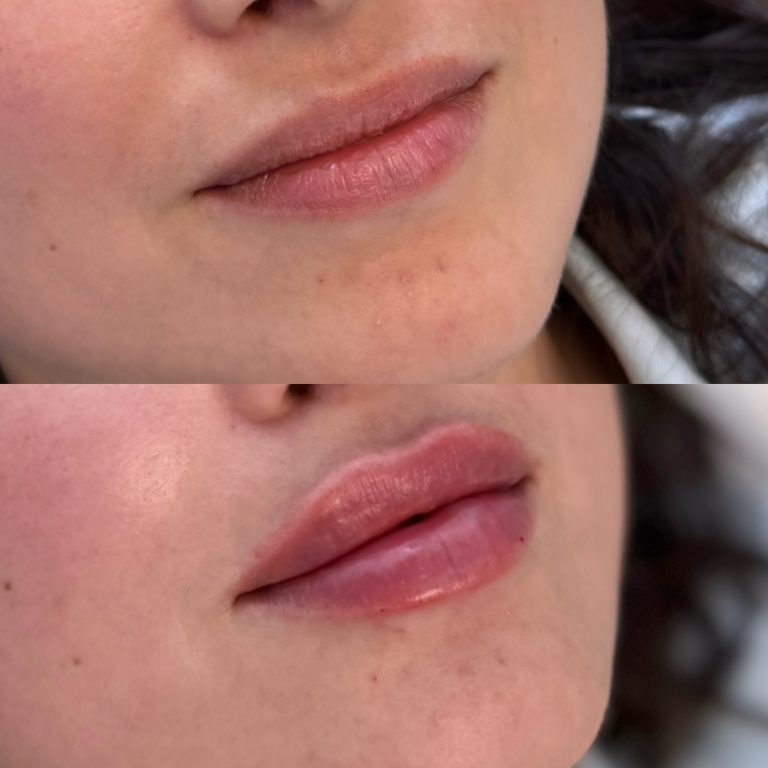 Injectare buze cu acid hialuronic