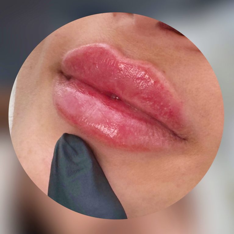 Injectare buze cu acid hialuronic