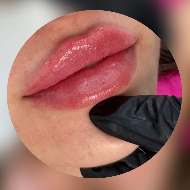 Buze volumizate cu acid hialuronic