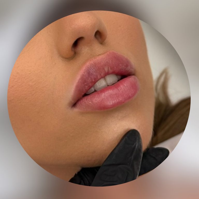 Injectare buze cu acid hialuronic