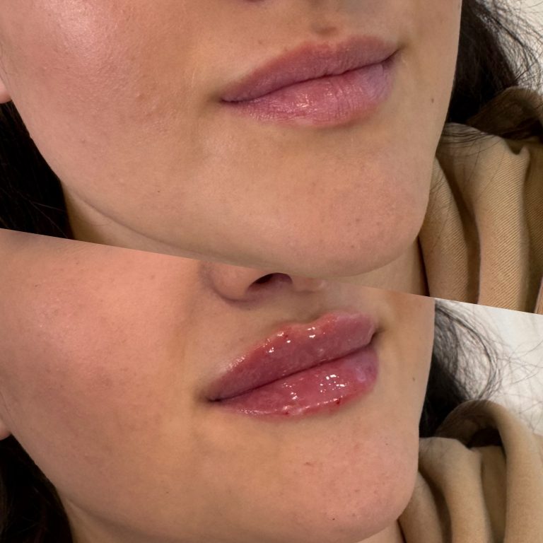 Buze volumizate cu acid hialuronic