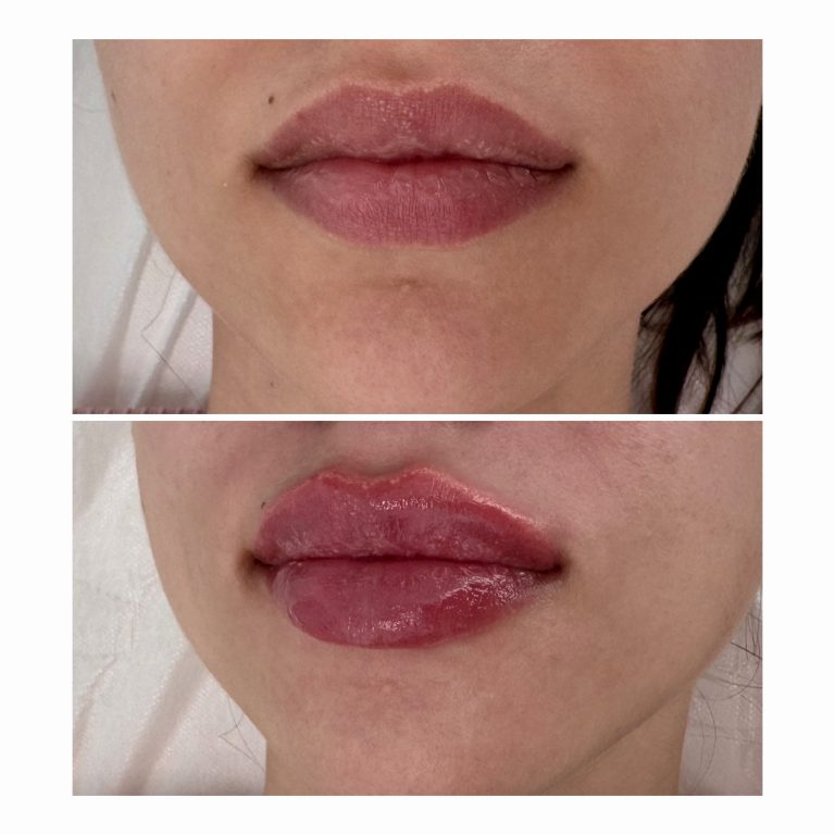 Buze volumizate cu acid hialuronic