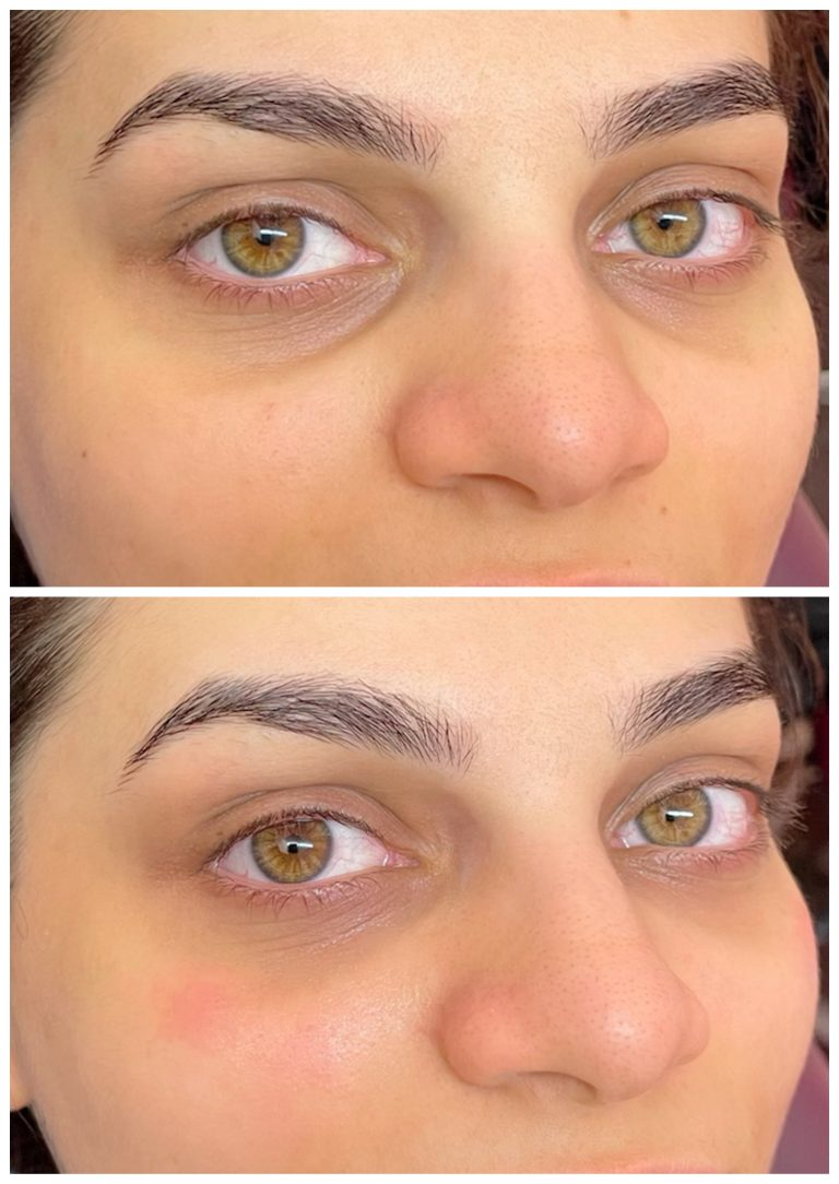 Umplere cearcane cu acid hialuronic 1