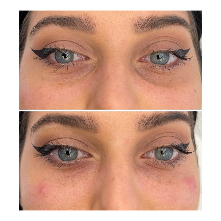 Umplere cearcane cu acid hialuronic 2