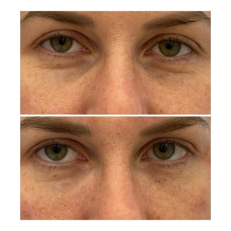 Umplere cearcane cu acid hialuronic 3